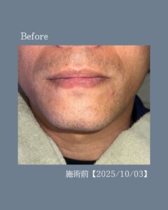 1FA163FB 4E54 4B2F 80F4 F0E66BE6400E ひげ脱毛13回の変化！沖縄メンズ脱毛