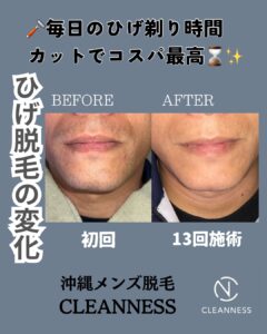 DCE0556A BCB3 40CA B936 43373A9F374E ひげ脱毛13回の変化！沖縄メンズ脱毛