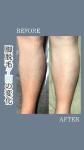 709F6C1C 98EC 436A 859E 71425A9F5A0B 脚脱毛7回の変化|沖縄メンズ脱毛