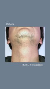 031A9B27 D8EE 4A09 B897 9DFA0FB49668 ひげ脱毛3回の変化|沖縄メンズ脱毛