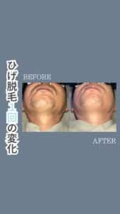 17119860 028D 47CD B2B8 92C2491FEB1E ひげ脱毛1回の変化|沖縄メンズ脱毛