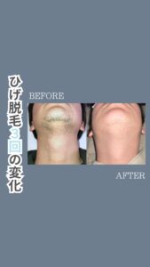 5C63FA3F 43E4 4528 97A5 32A136182E15 ひげ脱毛3回の変化|沖縄メンズ脱毛