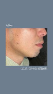 666F8EBA DB5B 46EA AD44 497F492FA42E ひげ脱毛8回の変化|沖縄メンズ脱毛