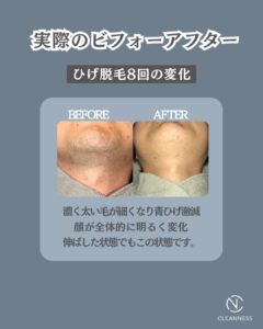 92BDC4DF F612 4DE9 96A8 F1C7578C9FCE ひげ脱毛途中経過|沖縄メンズ脱毛