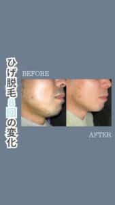 9F03D24E C529 4231 BDA7 55091F793FD4 ひげ脱毛8回の変化|沖縄メンズ脱毛