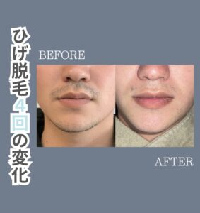AF542C80 D82D 499E 9E8D E2D60B6D9B30 ひげ脱毛４回の変化|沖縄メンズ脱毛