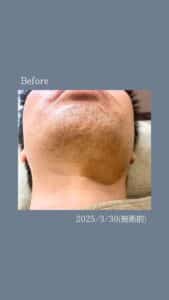 C7FE058C B770 45AD 8963 DFCE47E8A7AD ひげ脱毛3回の変化|沖縄メンズ脱毛