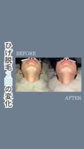 53E72336 C738 413C ADCA 5F8E98F32581 ひげ脱毛2回の変化|沖縄メンズ脱毛