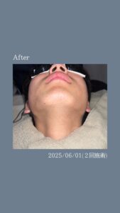 69E2EB2B 0622 478F 9542 2500A6A102D0 ひげ脱毛２回の変化|沖縄メンズ脱毛