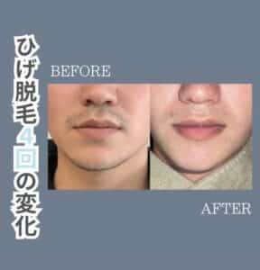 2D1D4905 5764 49A5 A909 6EDDEE95570B ひげ脱毛4回の変化|沖縄メンズ脱毛