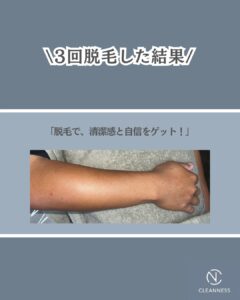 03C0468D A75C 4202 946D A1B06F025FC5 半袖・短パンためらってませんか？沖縄メンズ脱毛
