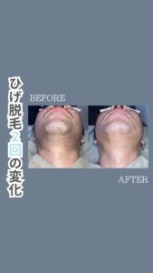 ひげ脱毛2回施術後の変化|沖縄メンズ脱毛 1 1A57480B 67F7 4CA3 ACED B777B12D5C9A ひげ脱毛2回施術後の変化|沖縄メンズ脱毛