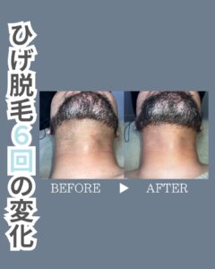 3ABBA183 0544 49BB 9688 BDDBF27867F7 30代・ひげ脱毛6回の変化|沖縄メンズ脱毛