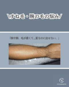 3E864129 D432 4D7E 830D 08E9E7E75189 半袖・短パンためらってませんか？沖縄メンズ脱毛