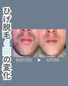 89819091 7E18 4D87 B736 CF052FDC491F 30代・ひげ脱毛6回の変化|沖縄メンズ脱毛