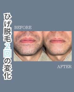 CE9D9A74 F4D8 4FBD 9C39 C3E1646C9D0D ひげ脱毛2回の変化|沖縄メンズ脱毛