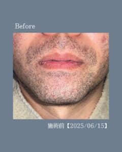CFE78A83 B177 4825 9C1E 63CCAC174DD1 ひげ脱毛2回の変化|沖縄メンズ脱毛