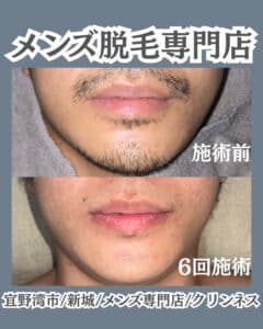 FF4C5D77 D9B6 4FCB 83A7 9D232ADA001D メンズ脱毛専門店|沖縄メンズ脱毛