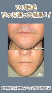 1E18810D 47C9 4F25 A9E4 1222C22CC521 ひげ脱毛3回の変化|沖縄メンズ脱毛専門店