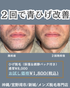 67B295FB 5A8C 4B79 B9DA 8A738FD482D4 30代・ひげ脱毛2回の変化|沖縄メンズ脱毛