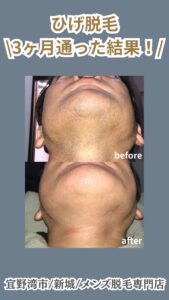 75945DC0 05A3 4B73 8226 D62B37AE0D65 ひげ脱毛3回の変化|沖縄メンズ脱毛専門店