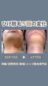 0426D2F4 4F8B 4440 B2B8 40598D8977E1 ひげ脱毛5回の変化|沖縄メンズ脱毛