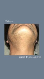 0B5C8118 DEDF 419A 8C0A 3E81FE5FA53B ひげ脱毛12回の変化|沖縄メンズ脱毛専門店