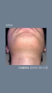 14E1F4F5 2D8F 48EA AA30 620C255554B6 ひげ脱毛5回の変化|沖縄メンズ脱毛