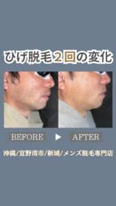 2504176E 3321 40FD 9502 D2D6D4D9F9F2 ひげ脱毛2回の変化|沖縄メンズ脱毛