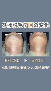 52656F7F 2AFD 462E 8B6E 329319991D54 ひげ脱毛７回の変化|沖縄メンズ脱毛専門店