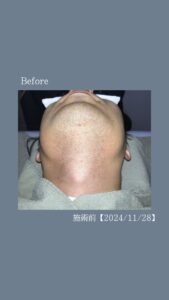 72EBE798 2465 4214 BB35 3084D8D7AF9B ひげ脱毛７回の変化|沖縄メンズ脱毛専門店