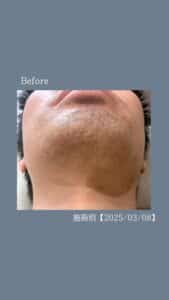 7E87C37D 1FC4 43B9 B2AD 96ED6B987090 ひげ脱毛5回の変化|沖縄メンズ脱毛