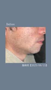 8985BE6D 7442 4687 B833 1A8FF9800C6A ひげ脱毛2回の変化|沖縄メンズ脱毛