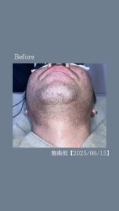 9BAE4895 1DAC 477A B5A6 52E231B2D160 40代・ひげ脱毛4回の変化|沖縄メンズ脱毛