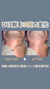 B49798B5 15E6 4BB1 B7C8 FD35E00119BC 毛穴も目立たなくなる？沖縄メンズ脱毛専門店