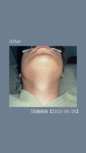 BE17557E BA5D 4787 A320 813F769DAFE2 ひげ脱毛７回の変化|沖縄メンズ脱毛専門店