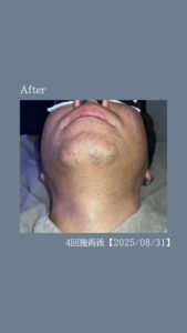 C66A7977 51A6 40D7 B153 0E9D9ECEC68D 40代・ひげ脱毛4回の変化|沖縄メンズ脱毛