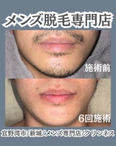 D05699F4 340C 4F3C 8D8D 1254EEFAEDA9 ひげ脱毛を最短で卒業したい方の為の脱毛サロン！沖縄メンズ脱毛専門店