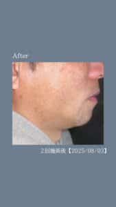 FB633BBF 3A06 4CC5 9757 59A07A06D6CD ひげ脱毛2回の変化|沖縄メンズ脱毛