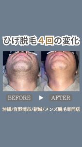 FDC68EA9 A84F 4508 9373 C5222EF7995C 40代・ひげ脱毛4回の変化|沖縄メンズ脱毛