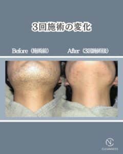 0DDF57C0 82D5 43A1 9DE1 958E14A1F905 青ひげの原因と脱毛という選択|沖縄メンズ脱毛専門店