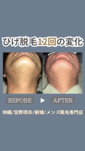ひげ脱毛12回の変化|沖縄メンズ脱毛専門店 1 35D3A79B C988 43D8 BF6B 5E84E6FD27B4 ひげ脱毛12回の変化|沖縄メンズ脱毛専門店