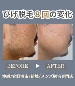 63C4E8DD 7168 470E ADD4 6BCD6A7F0AED ひげを剃る手間も肌荒れも無くなり一石二鳥のひげ脱毛|沖縄メンズ脱毛専門店
