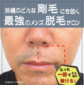 72C50B86 128A 431D A6BD 11B3A7F690BC 沖縄県でメンズ脱毛をお探しの方へ！沖縄メンズ脱毛