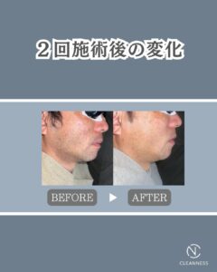 7D4B886E 1BDC 4253 9ABF 0D807AF11F37 ひげ脱毛同じ機械でも技術で効果3倍！沖縄メンズ脱毛