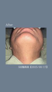 ひげ脱毛12回の変化|沖縄メンズ脱毛専門店 3 8835B5E2 56E3 4F75 8320 B6CD6888812F ひげ脱毛12回の変化|沖縄メンズ脱毛専門店