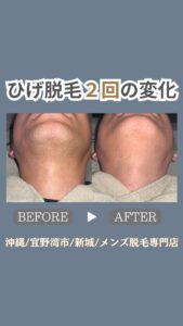 ひげ脱毛2回の変化|沖縄メンズ脱毛 1 41D87D11 7604 4234 A933 54DFB52F290F ひげ脱毛2回の変化|沖縄メンズ脱毛