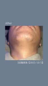 ひげ脱毛4回の変化|沖縄メンズ脱毛 3 83DFCD4B FB75 4E01 B952 173B0AFCD907 ひげ脱毛4回の変化|沖縄メンズ脱毛