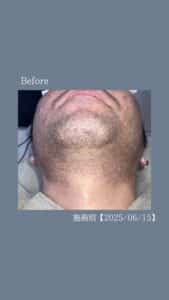 ひげ脱毛4回の変化|沖縄メンズ脱毛 2 A341D790 61DA 47CD 9C73 131961708835 ひげ脱毛4回の変化|沖縄メンズ脱毛