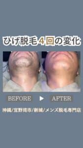 ひげ脱毛4回の変化|沖縄メンズ脱毛 1 C0ADB0A9 FA2A 4FAA 9110 3335D9F64AE6 ひげ脱毛4回の変化|沖縄メンズ脱毛